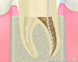 歯の根の治療